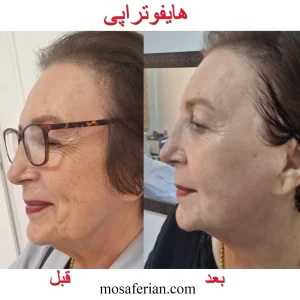 هایفوتراپی قبل و بعد