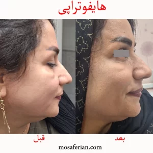 هایفوتراپی قبل و بعد