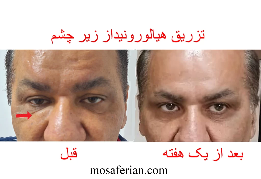 تزریق هیالورونیداز زیر چشم