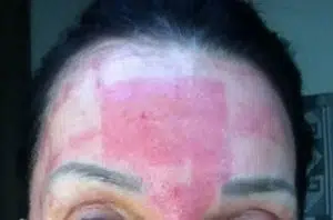 قرمزی التهابی پوست بعد از لیزر