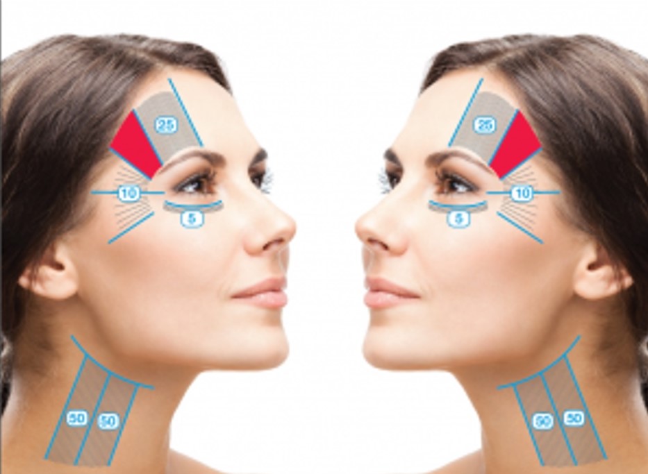 هایفوتراپی دور چشم