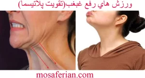 تقویت عضله پلاتیسما در گردن 
