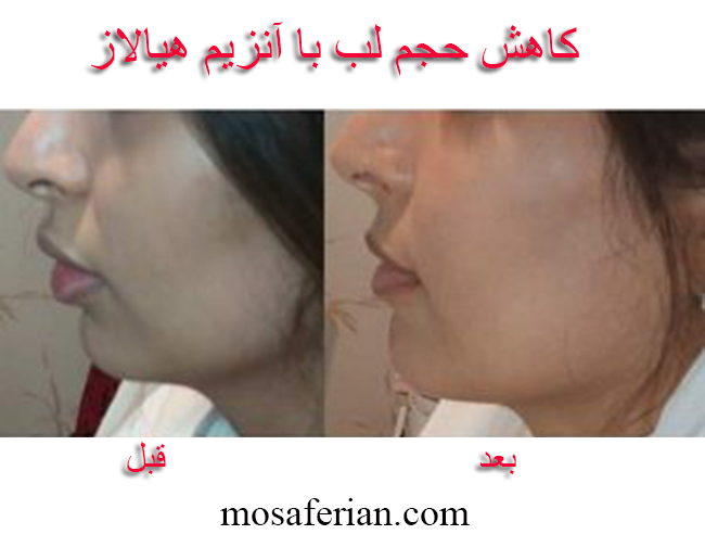 کاهش حجم لب با آنزیم هیالاز