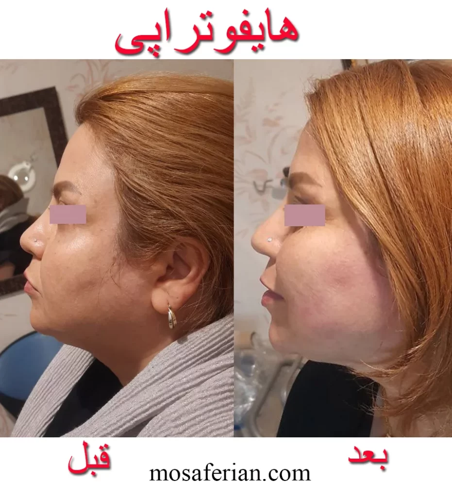رفع غبغب و لیفت صورت بعد از هایفو