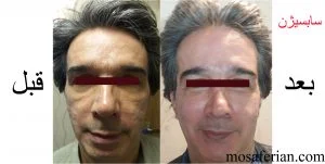 قبل و بعد درمان با روش ترکیبی لیزر ، سابسیژن و تزریق چربی