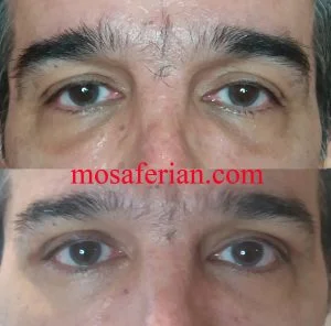 تزریق چربی زیر چشم قبل و بعد