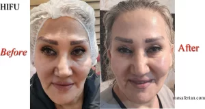 تصویر قبل و بعد جوانسازی در صورت یک خانم