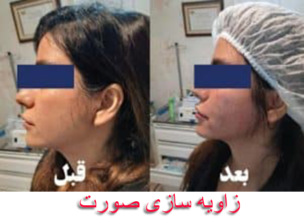زوایه سازی صورت قبل و بعد