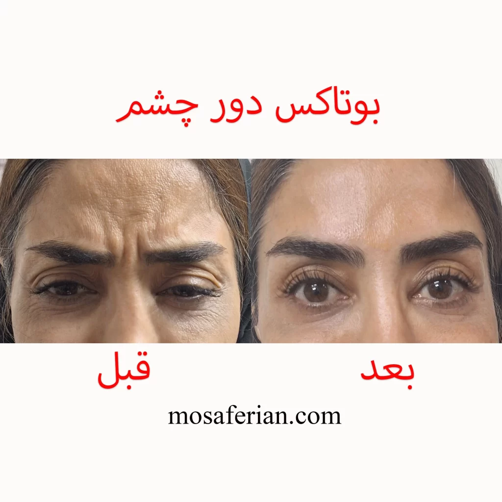 تزریق بوتاکس قبل و بعد