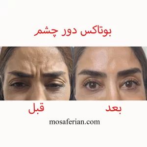 تزریق بوتاکس قبل و بعد