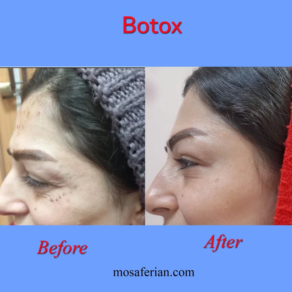 بوتاکس پنجه کلاغی