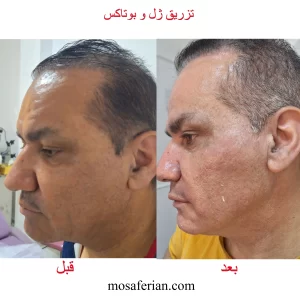 تزریق ژل و بوتاکس قبل و بعد