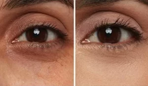 قبل و بعد درمان تیرگی زیر چشم با مزوژل جالپرو