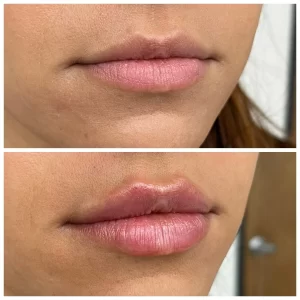 تزریق ژل لب مدل قلوه ای قبل و بعد