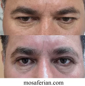 جراحی پلک در مردان قبل و بعد
