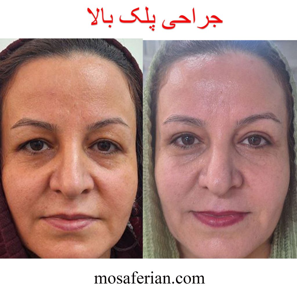 جراحی پلک قبل و بعد
