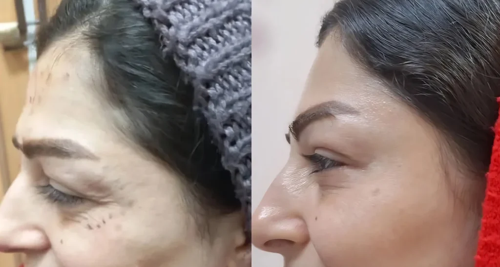 بوتاکس چشم گربه ای موجب بالا کشیدن انتهای ابرو می شود