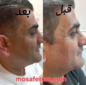 بوتاکس چشم گربه ای قبل و بعد