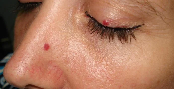 خال قرمز روی بینی